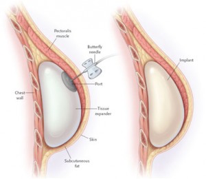 tissue-expander-illustration-300x260